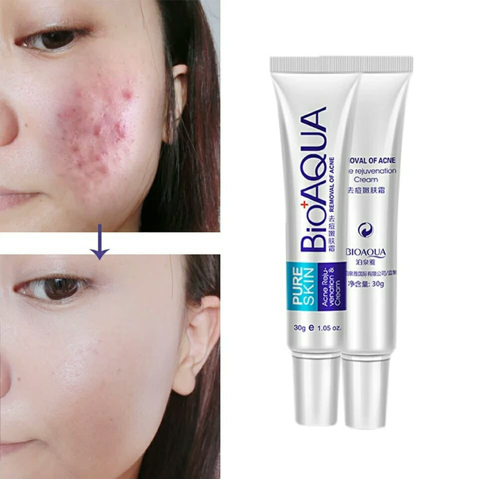 KIT ANTI ACNE BIOAQUA